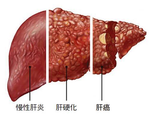 慢性肝炎-肝硬化-肝癌.png